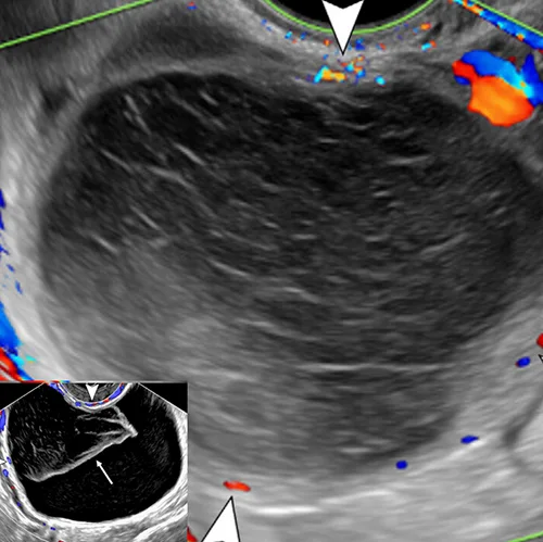 Typical hemorrhagic cyst *