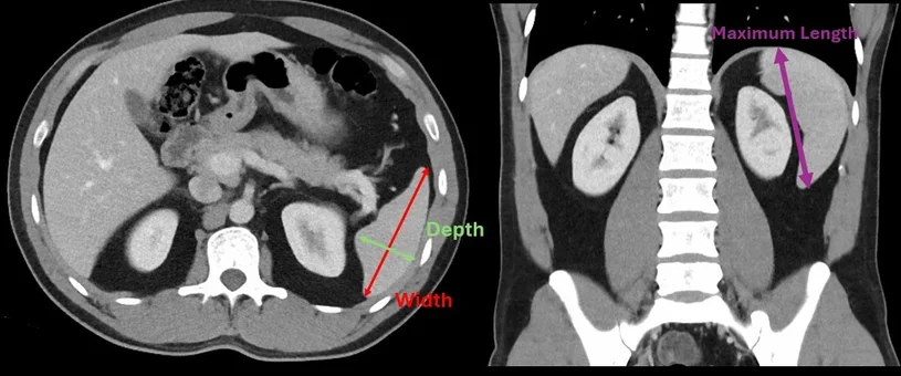 spleen volume calculator splenic index calculator us mri ct