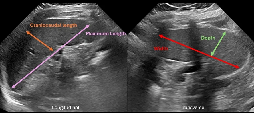 spleen volume calculator splenic index calculator us mri ct