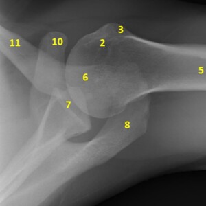 1. anatomical neck of humerus
2. greater tuberosity
3. lesser tuberosity
4. surgical neck of humerus
5. humeral shaft
6. humeral head
7, glenoid fossa
8. acromion
9. acromioclavicular joint
10. coracoid process
11. clavicle
12.superior angle of scapula
13. medial border of scapula
14. inferior angle of scapula
15. lateral border of scapula
16. scapula shoulder radiograph annotated