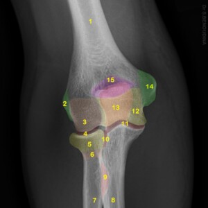 1. Humerus
2. Lateral epicondyle
3. Capitellum
4. Humero-radial joint
5. Radial head
6. Radial neck
7. Radius (Shaft)
8. Ulna (Shaft)
9. Radial tuberosity
10. Proximal radio-ulnar joint
11. Humero-ulnar joint
12. Trochlea of humerus
13. Olecranon
14. Medial epicondyle
15. Olecranon fossa
16. Trochlear notch
17. Coronoid fossa
18. Coronoid process
19. Ulnar tuberosity elbow radiograph annotated