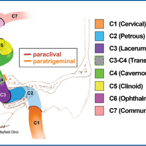Marcati, Eleonora et al. “Paratrigeminal, Paraclival, Precavernous, or All of the Above? A Circumferential Anatomical Study of the C3-C4 Transitional Segment of the Internal Carotid Artery.” Operative neurosurgery 14 4 (2018): 432-440 . ICA segments diagram
