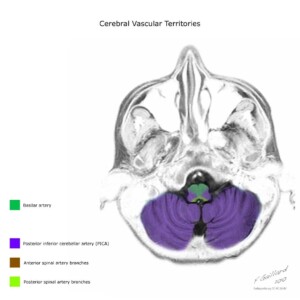 Case courtesy of Frank Gaillard, Radiopaedia.org, rID: 10814 cerebral vascular territories diagram