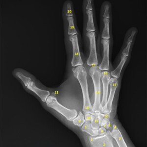 1. Styloid process of radius.
2. Metaphysis of radius.
3. Metaphysis of ulna.
4. Styloid process of ulna.
5. Scaphoid.
6. Lunate.
7. Triquetrum.
8. Pisiform.
9. Trapezium.
10. Trapezoid.
11. Capitate.
12. Hamate.
13. Base of second metacarpal.
14. Shaft of third metacarpal.
15. Neck of fifth metacarpal.
16. Head of forth metacarpal.
17. Metacarpophalangeal joint.
18. Proximal phalanx.
19. Middle phalanx.
20. Distal phalanx.
21. Sesamoid bones (flexor pollicis brevis, adductor pollicis).
22. Terminal tuft hand radiograph annotated