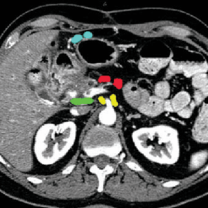 Light blue: right gastroepiploic -- Green: periportal -- Yellow: superior mesenteric -- Red: inferior pancreatic Radiology abdominal lymph node stations