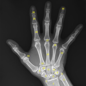 1. Styloid process of radius.
2. Metaphysis of radius.
3. Metaphysis of ulna.
4. Styloid process of ulna.
5. Scaphoid.
6. Lunate.
7. Triquetrum.
8. Pisiform.
9. Trapezium.
10. Trapezoid.
11. Capitate.
12. Hamate.
13. Base of second metacarpal.
14. Shaft of third metacarpal.
15. Neck of fifth metacarpal.
16. Head of forth metacarpal.
17. Metacarpophalangeal joint.
18. Proximal phalanx.
19. Middle phalanx.
20. Distal phalanx.
21. Sesamoid bones (flexor pollicis brevis, adductor pollicis).
22. Terminal tuft hand radiograph annotated