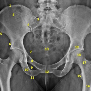 1. Iliac crest
2. Ilium
3. Anterior sacral foramina
4. Sacroiliac joint
5. Anterior superior iliac spine
6. Anterior inferior iliac spine
7. Ischial spine
8. Superior pubic ramus
9. Obturator foramen
10. Inferior pubic ramus
11. Ischial tuberosity
12. Symphysis pubis
13. Coccyx
14. Femur
15. Lesser trochanter
16. Greater trochanter
17. Femoral neck
18. Femoral head
19. Acetabulum pelvis radiograph annotated