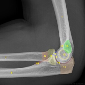 1. Humerus
2. Lateral epicondyle
3. Capitellum
4. Humero-radial joint
5. Radial head
6. Radial neck
7. Radius (Shaft)
8. Ulna (Shaft)
9. Radial tuberosity
10. Proximal radio-ulnar joint
11. Humero-ulnar joint
12. Trochlea of humerus
13. Olecranon
14. Medial epicondyle
15. Olecranon fossa
16. Trochlear notch
17. Coronoid fossa
18. Coronoid process
19. Ulnar tuberosity elbow radiograph annotated