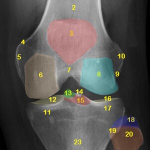 1. Femoral shaft.
2. Distal femoral metaphysis.
3. Patella.
4. Adductor tubercle.
5. Medial femoral epicondyle.
6. Medial condyle.
7. Intercondylar notch.
8. Lateral condyle.
9. Popliteal groove.
10. Lateral femoral epicondyle.
11. Medial condyle of tibia.
12. Medial tibial plateau
13. Medial tibial spine.
14. Lateral tibial spine.
15. Intercondylar eminence (Tibial eminence).
16. Lateral tibial plateau.
17. Lateral condyle of tibia.
18. Fibular styloid process.
19. Proximal tibiofibular joint.
20. Fibular head.
21. Fibular neck.
22. Tibial shaft.
23. Tibial proximal metaphysis.
24. Quadriceps tendon.
25. Base of patella.
26. Appex of patella.
27. Patellar ligament.
28. Infrapatellar fat pad (Hoffa's fat pad).
29. Fabella.
30. Tibial tuberosity. knee radiograph annotated