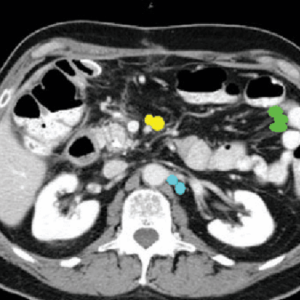 Green: juxtaintestinal -- Light blue: renal hilar -- Yellow: superior mesenteric Radiology abdominal lymph node stations