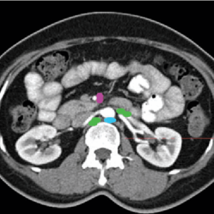 Green: renal hilar -- Light blue: retro-aortic -- Pink: superior mesenteric Radiology abdominal lymph node stations