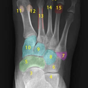 1. Medial malleolus
2. Lateral malleolus
3. Head of talus
4. Calcaneus
5. Navicular
6. Cuboid
7. Base of fifth metatarsal
8. Third cuneiform (lateral)
9. Second cuneiform (Intermediate)
10. First cuneiform (medial)
11. Medial sesamoid
12. Lateral sesamoid
13. Shaft of second metatarsal
14. Neck of third metatarsal
15. Head of fourth metatarsal
16. Metatarsophalangeal joint
17. Proximal phalanx
18. Middle phalanx
19. Distal phalanx foot radiograph annotated