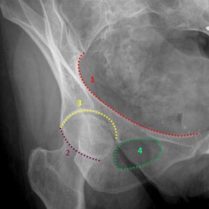 1. iliopectineal line
2. posterior acetabular wall
3. acetabular roof
4. obturator foramen Hip radiograph annotated