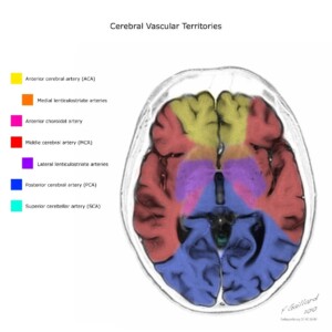 Case courtesy of Frank Gaillard, Radiopaedia.org, rID: 10814 cerebral vascular territories diagram