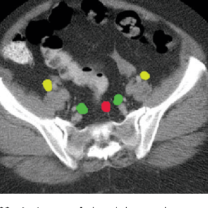 Green: internal iliac (hypogastric) -- Yellow: external iliac -- Red: superior rectal Radiology abdominal lymph node stations