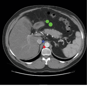 Red: retrocrural -- Blue: inferior diaphragmatic -- Green: middle colic Radiology abdominal lymph node stations
