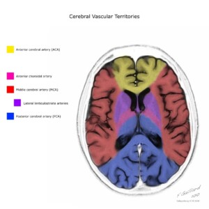 Case courtesy of Frank Gaillard, Radiopaedia.org, rID: 10814 cerebral vascular territories diagram
