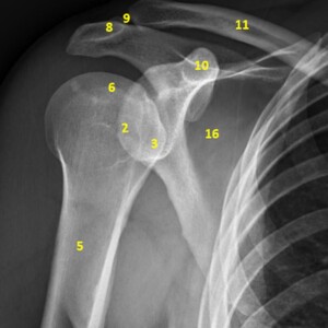 1. anatomical neck of humerus
2. greater tuberosity
3. lesser tuberosity
4. surgical neck of humerus
5. humeral shaft
6. humeral head
7, glenoid fossa
8. acromion
9. acromioclavicular joint
10. coracoid process
11. clavicle
12.superior angle of scapula
13. medial border of scapula
14. inferior angle of scapula
15. lateral border of scapula
16. scapula shoulder radiograph annotated