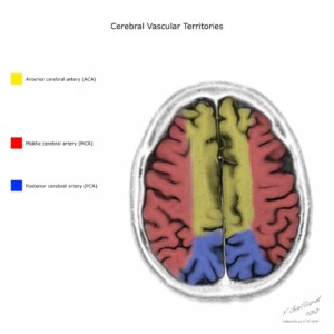 Case courtesy of Frank Gaillard, Radiopaedia.org, rID: 10814 cerebral vascular territories diagram