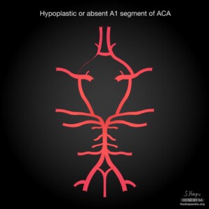 Hypoplastic/absent A1 Circle of willis diagram