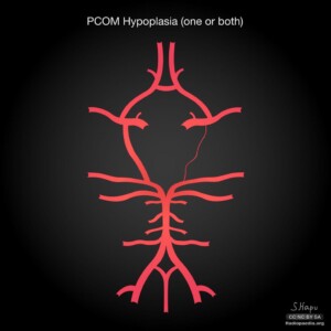 PCOM Hypoplasia Circle of willis diagram
