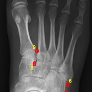 Common accessory ossicles ot the foot:
1. os trigonum
2. os supratalare
3. os supranaviculare
4. os calcaneus secundaris
5. os peroneum
6. os vesalianum
7. os tibiale externum
8. os intercuneiforme
9. os intermetatarseum