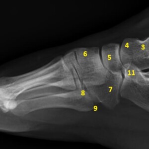 1. Tibia
2. Dome of talus
3. Neck of talus
4. Head of talus
5. Navicular
6. Superimposed cuneiforms
7. Cuboid
8. Base of fifth metatarsal
9. Styloid process of fifth metatarsal
10. Calcaneus
11. Anterior tubercle of calcaneus
12. Middle tubercle of calcaneus
13. Posterior tubercle of calcaneus foot radiograph annotated