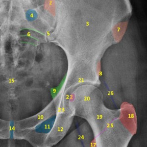 1. Iliac crest
2. Posterior superior iliac spine
3. Ilium
4. Anterior sacral foramina
5. Sacroiliac joint
6. Sacral Arcuate lines
7. Anterior superior iliac spine
8. Anterior inferior iliac spine
9. Ischial spine
10. Superior pubic ramus
11. Obturator foramen
12. Inferior pubic ramus
13. Ischial tuberosity
14. Symphysis pubis
15. Coccyx
16. Femur
17. Lesser trochanter
18. Greater trochanter
19. Femoral neck
20. Femoral head
21. Acetabulum
22. Fovea centralis
23. Koehler's teardrop
24. Psoas fat pad
25. Intertrochanteric crest
26. Gluteal fat pad hip radiograph annotated