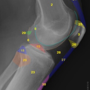 1. Femoral shaft.
2. Distal femoral metaphysis.
3. Patella.
4. Adductor tubercle.
5. Medial femoral epicondyle.
6. Medial condyle.
7. Intercondylar notch.
8. Lateral condyle.
9. Popliteal groove.
10. Lateral femoral epicondyle.
11. Medial condyle of tibia.
12. Medial tibial plateau
13. Medial tibial spine.
14. Lateral tibial spine.
15. Intercondylar eminence (Tibial eminence).
16. Lateral tibial plateau.
17. Lateral condyle of tibia.
18. Fibular styloid process.
19. Proximal tibiofibular joint.
20. Fibular head.
21. Fibular neck.
22. Tibial shaft.
23. Tibial proximal metaphysis.
24. Quadriceps tendon.
25. Base of patella.
26. Appex of patella.
27. Patellar ligament.
28. Infrapatellar fat pad (Hoffa's fat pad).
29. Fabella.
30. Tibial tuberosity. knee radiograph annotated